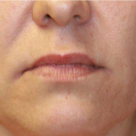 35-44 year old woman treated with Lip Lift before 3560876