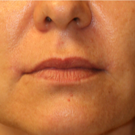 35-44 year old woman treated with Lip Lift after 3560876