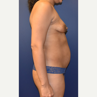 35-44 year old woman treated with Sientra Breast Implants before 3049658