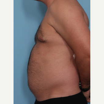35-44 year old man treated with Fat Transfer before 3577856