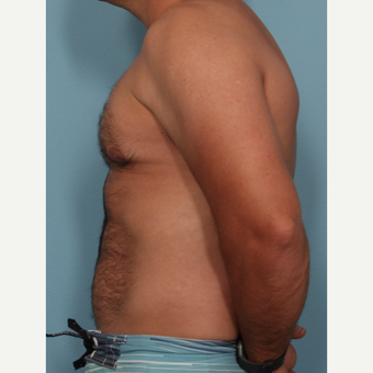 35-44 year old man treated with Fat Transfer after 3577856