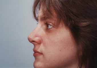 Revision Rhinoplasty after 358579