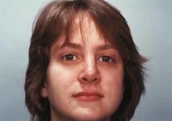 Revision Rhinoplasty 358579