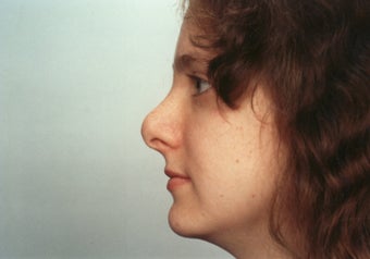 Revision Rhinoplasty before 358579