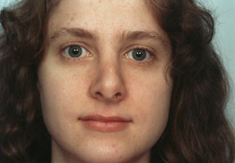 Revision Rhinoplasty 358579