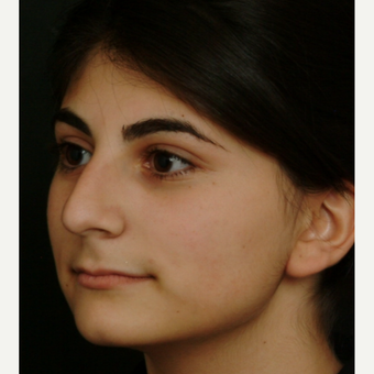 17 or under year old woman treated with Rhinoplasty before 3582834