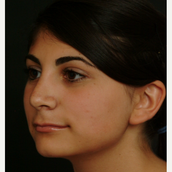 17 or under year old woman treated with Rhinoplasty after 3582834