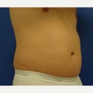 CoolSculpting 1594697