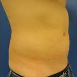 CoolSculpting 1594697