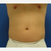 CoolSculpting before 1594697