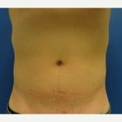 CoolSculpting after 1594697