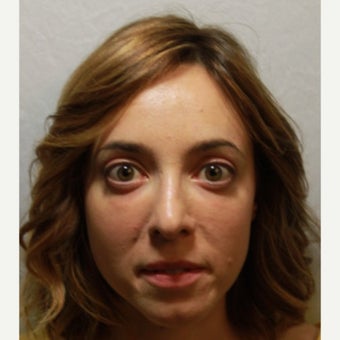 25-34 year old woman treated with Radiesse to her tear trough and lower eyelids after 2354017