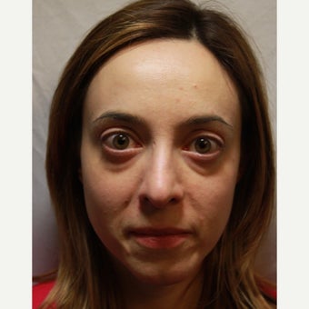25-34 year old woman treated with Radiesse to her tear trough and lower eyelids before 2354017