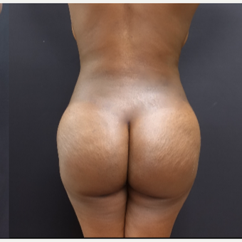 25-34 year old woman treated with Butt Lift after 3363867