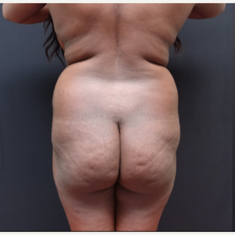 25-34 year old woman treated with Butt Lift before 3363867