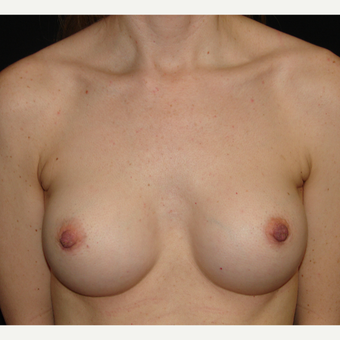 35-44 year old woman treated with Breast Implants after 3303975