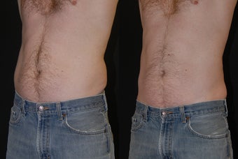 CoolSculpting Male to abdomen and love handles before 1376635