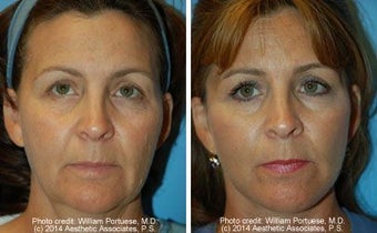 Facelift before 91424
