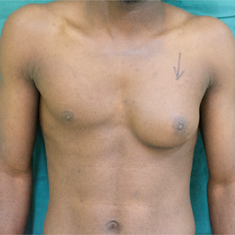 25-34 year old man treated with Male Breast Reduction before 3705152