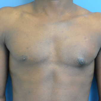 25-34 year old man treated with Male Breast Reduction after 3705152