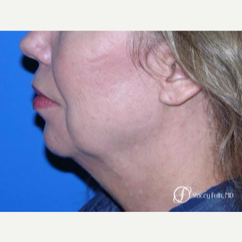 55-64 year old woman treated with Facelift before 3305374