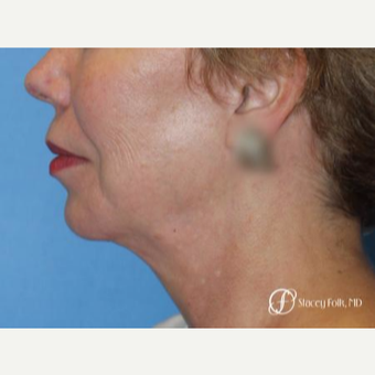 55-64 year old woman treated with Facelift after 3305374