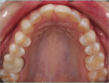 35-44 year old woman treated with Lingual Braces before 3498168