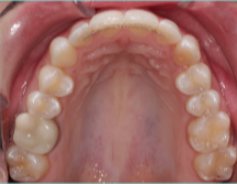 35-44 year old woman treated with Lingual Braces after 3498168