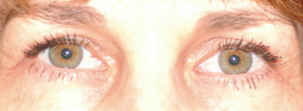 Forehead Lift On Middle-aged Female after 1499339
