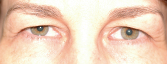 Forehead Lift On Middle-aged Female before 1499339