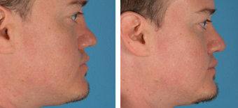 Revision Rhinoplasty before 1208292