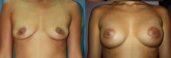 30 years female underwent bresst augmentation using 280 cc silicone gel implant after 932111