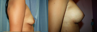30 years female underwent bresst augmentation using 280 cc silicone gel implant before 932111