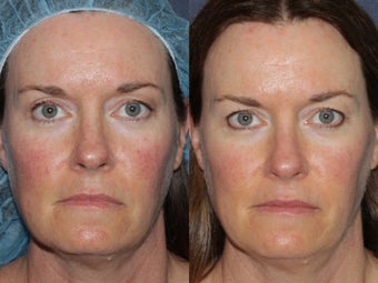 Before & After IPL before 806247