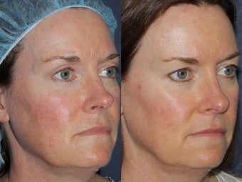 Before & After IPL after 806247