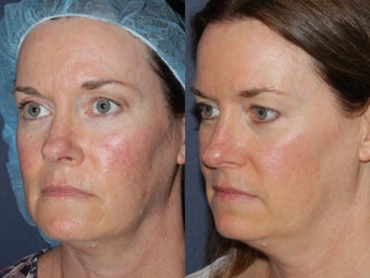 Before & After IPL 806247