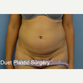45-54 year old woman treated with Tummy Tuck before 3368727