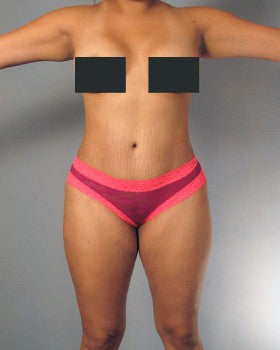 Liposuction and Tummy Tuck - 27 year old female after 1231379