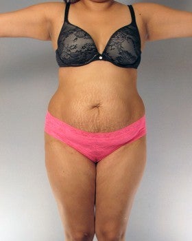 Liposuction and Tummy Tuck - 27 year old female before 1231379