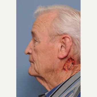 75 and up year old man treated with Mohs Surgery before 2435812