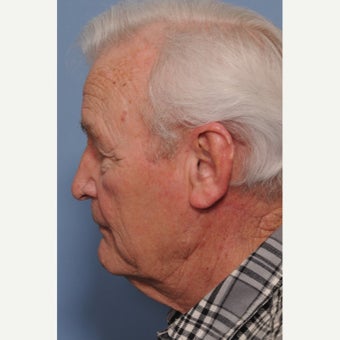 75 and up year old man treated with Mohs Surgery after 2435812