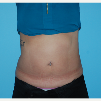 25-34 year old woman treated with SculpSure after 3065497