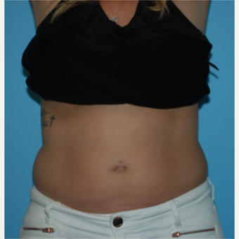 25-34 year old woman treated with SculpSure before 3065497