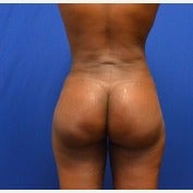 45-54 year old woman treated with Brazilian Butt Lift 1854562