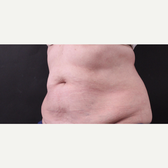 62 year old woman treated with CoolSculpting after 3221059