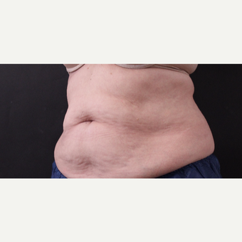 62 year old woman treated with CoolSculpting before 3221059