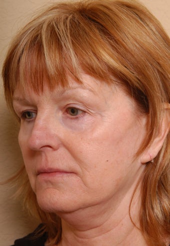 Refresher Facelift w/Cheeklift, Browlift, Fat Injections to Cheeks, & Lips, Neck Plication, Upper Blepharoplasty before 252907