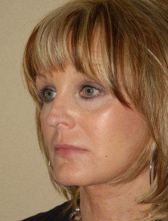 Refresher Facelift w/Cheeklift, Browlift, Fat Injections to Cheeks, & Lips, Neck Plication, Upper Blepharoplasty after 252907