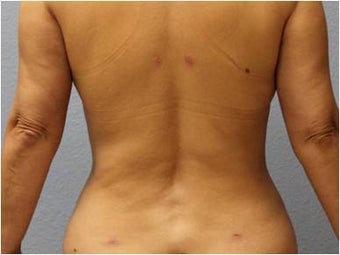 45-54 year old woman treated with Liposuction 3726463