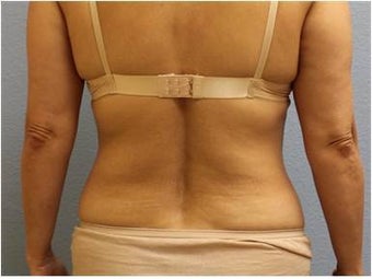 45-54 year old woman treated with Liposuction 3726463